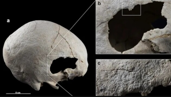 Жінка мідної доби пережила дві трепанації черепа ще 4500 років тому