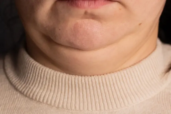 Зображення шиї людини з дещо обвислою шкірою. На людині кремовий светр з круглим вирізом