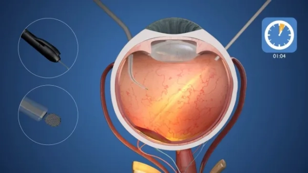 Конкурент Ілона Маска створює революційний очний чіп, який вперше у світі відновлює зір